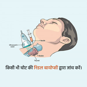Illustration of a thyroid nodule biopsy using ultrasound guidance