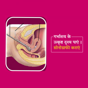 Medical illustration of a Hysterosalpingography procedure showing the uterus and fallopian tubes.