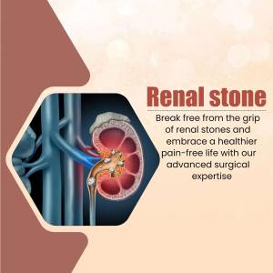 Illustration of a kidney with a stone, promoting advanced surgical expertise for renal stone treatment.