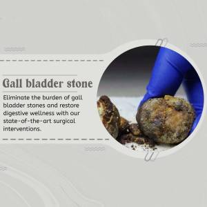 Close-up of a gallbladder stone being held with surgical gloves, illustrating a medical condition.