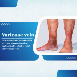 Close-up of legs with visible varicose veins, advertising treatment options.