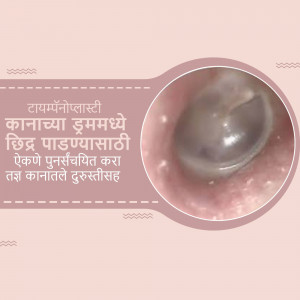 Image showing an ear drum before and after tympanoplasty surgery.