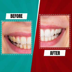 Before and after comparison of teeth whitening results