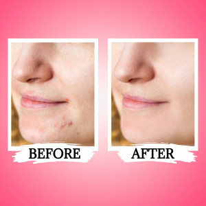 Before and after image showing improvement in acne-prone skin.